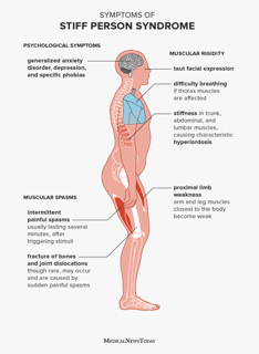 Picture of stiff-person syndrome