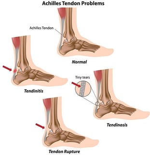 Picture of Ankle Injuries
