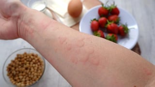 Picture of peanut allergy