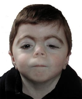 Picture of Cornelia de Lange syndrome