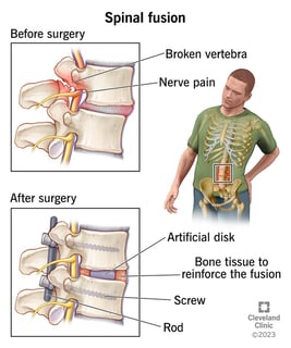 Picture of Spinal fusion