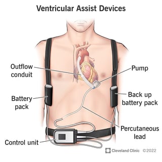 Picture of Ventricular assist device