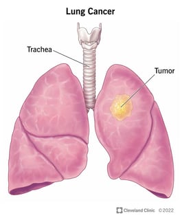 Picture of lung