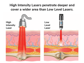Picture of Low-level laser therapy