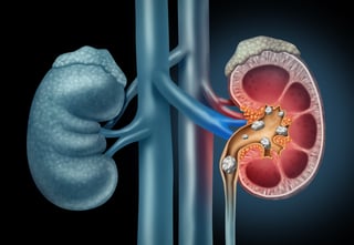 Picture of kidney stone