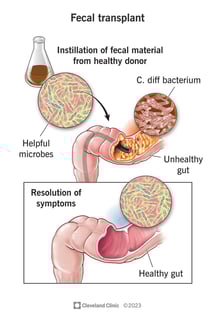 Picture of Fecal microbiota transplant