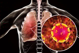 Picture of Middle East respiratory syndrome