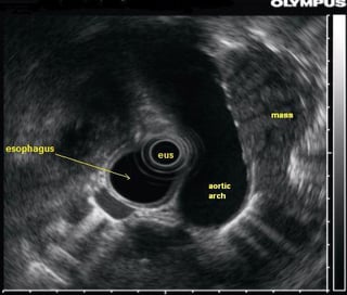 Picture of Endoscopic ultrasound