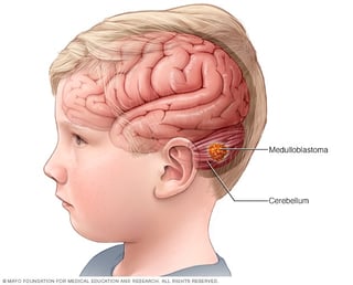 Picture of medulloblastoma