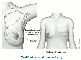Picture of Mastectomy