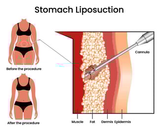 Picture of Liposuction