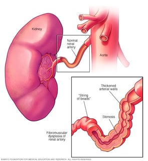 Picture of fibromuscular dysplasia