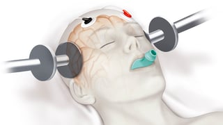 Picture of Electroconvulsive therapy