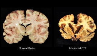 Picture of chronic traumatic encephalopathy