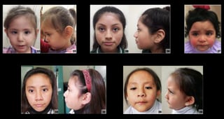 Picture of Turner syndrome