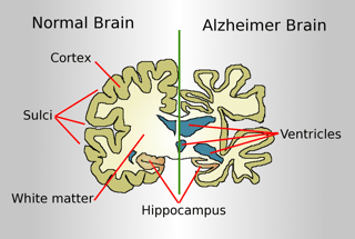 Picture of Alzheimer's disease