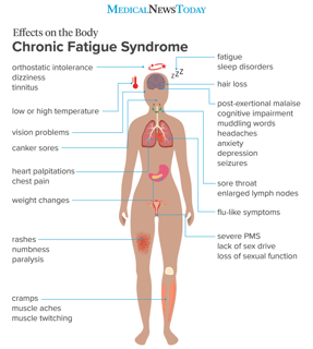 Picture of chronic fatigue syndrome