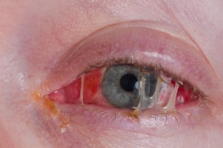 Picture of Eye Infections