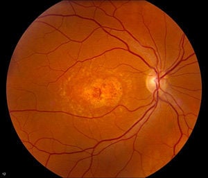 Picture of Stargardt disease