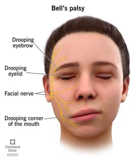 Picture of Bell's palsy
