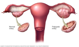 Picture of polycystic ovary syndrome