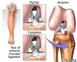 Picture of cruciate ligament injury