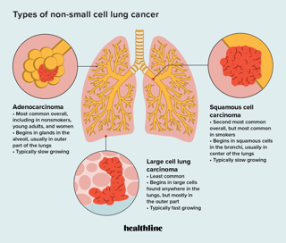 Picture of non-small-cell lung carcinoma