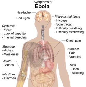 Picture of Ebola hemorrhagic fever