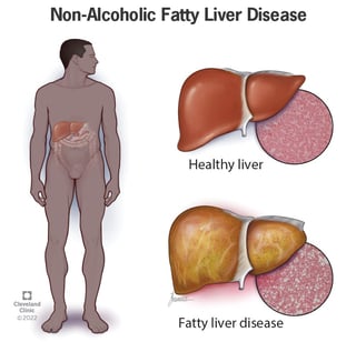 Picture of non-alcoholic fatty liver disease