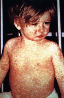 Picture of measles