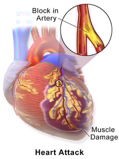 Picture of myocardial infarction
