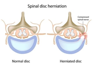 Picture of spinal disc herniation
