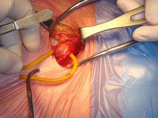 Picture of Inguinal hernia surgery