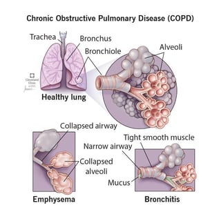 Picture of chronic obstructive pulmonary disease