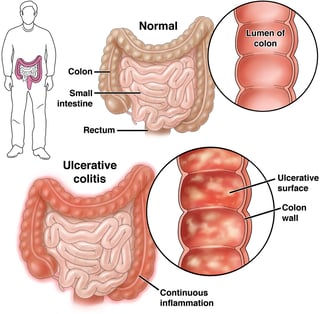 Picture of ulcerative colitis