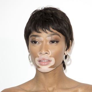Picture of vitiligo
