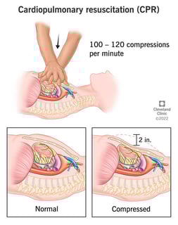 Picture of Cardiopulmonary resuscitation