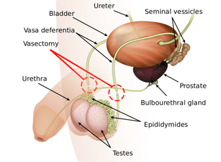 Picture of Vasectomy