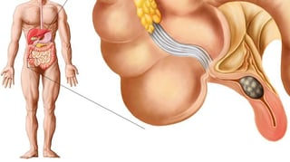 Picture of appendicitis