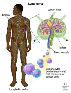 Picture of lymphoma