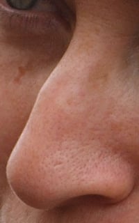 Picture of nose