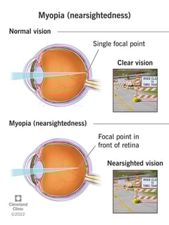 Picture of myopia