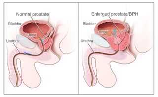 Picture of prostatic hypertrophy