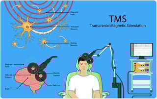 Picture of Transcranial magnetic stimulation