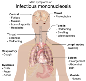 Picture of Infectious mononucleosis