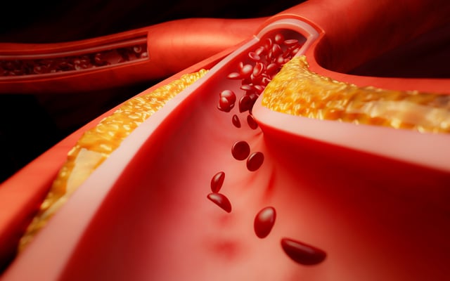 Hyperlipidemia or arteriosclerosis. Blocked artery concept and human blood vessel as a disease with cholesterol fat buildup clogging. Clogged arteries, Cholesterol plaque in the artery. 3D Rendering