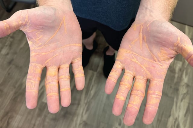 cholesterol on hands