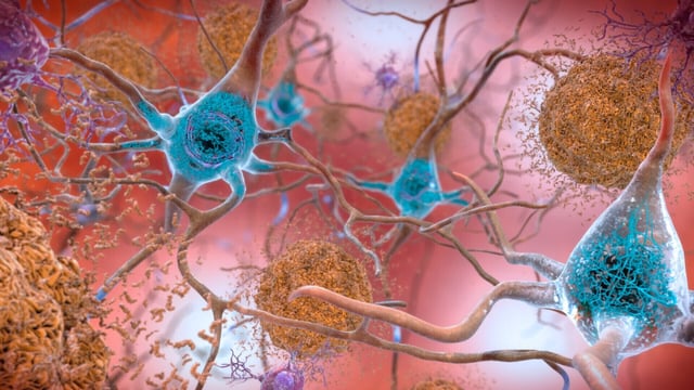Researchers followed 18,700 adults who had been diagnosed with dementia
