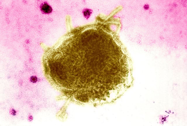 This Electron Micrograph Reveals Both A Paramyxovirus Measles Virus, And Virions Of The Polyomavirus, Simian Virus Sv40 Smaller Circles. The Envelope Of The Measles Virus Has Broken, Exposing The Nucleocapsid Filaments. Interest In Sv40 Has Increased In The Last Several Years Because The Virus Was Found In Certain Forms Of Cancer In Humans, For Instance Mesotheliomas Rare Tumors Located In The Lungs, Brain, And Bone Tumors Carbone Et Al. , 1994; Jasani Et Al. , 2001. (Photo By BSIP/UIG Via Getty Images)