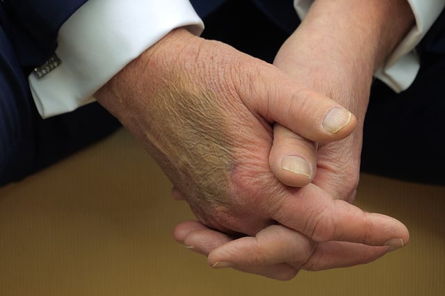 Makeup covers a bruise on the back of U.S. President Donald Trump&#39;s hand on February 24, 2025 in Washington, DC.
